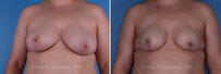 Breast reconstruction surgery before and after photos