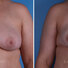 Breast reconstruction surgery before and after photos