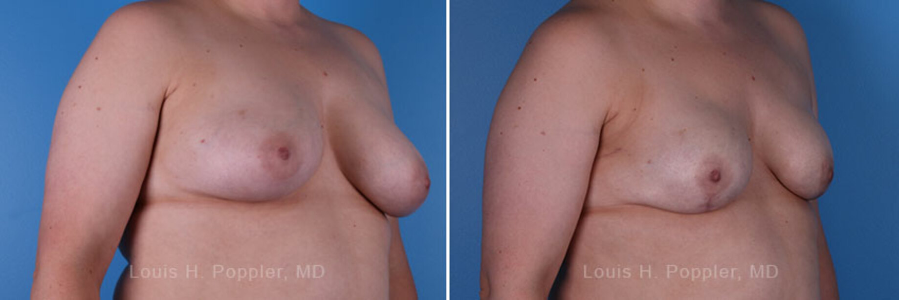 Breast reconstruction surgery before and after photos, right 45-degree angle view