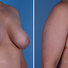 Breast reconstruction surgery before and after photos, right 45-degree angle view
