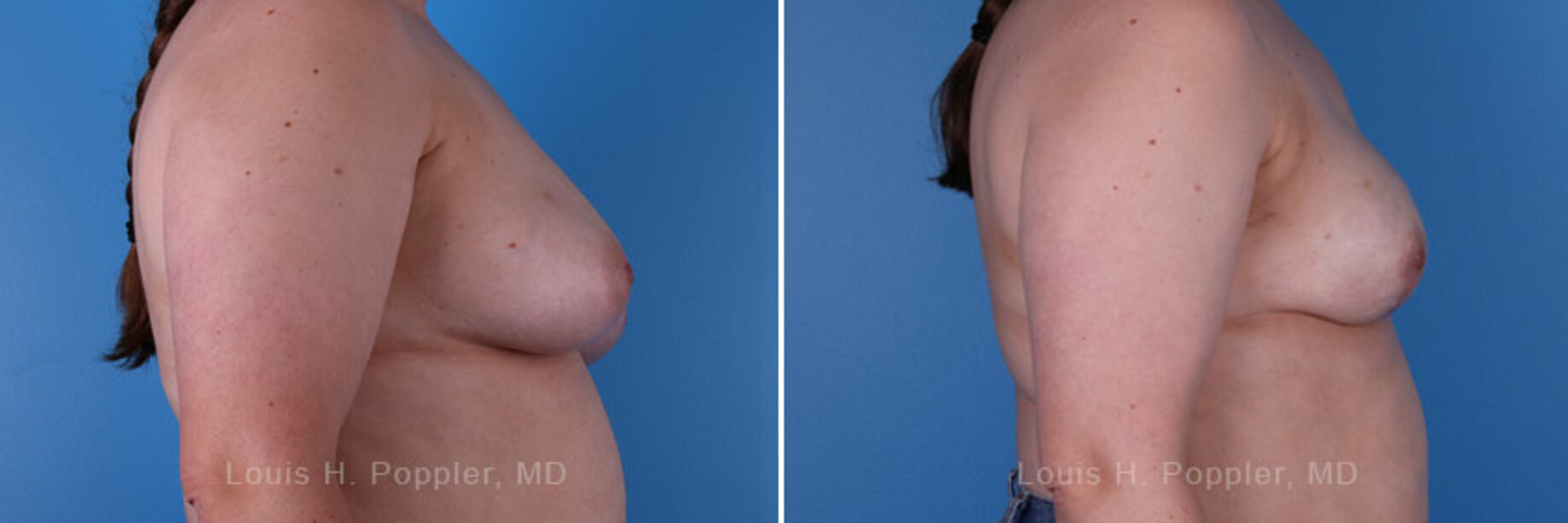 Breast reconstruction surgery before and after photos, right 90-degree angle view