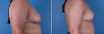Breast reconstruction surgery before and after photos, right 90-degree angle view