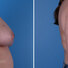Breast reconstruction surgery before and after photos, right 90-degree angle view