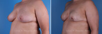 Breast reconstruction surgery before and after photos, left 45-degree angle view