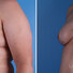 Breast reconstruction surgery before and after photos, left 45-degree angle view