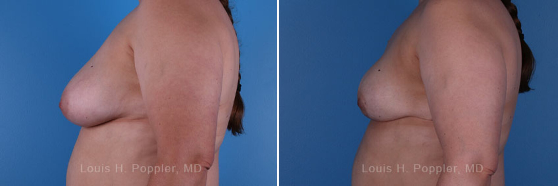 Breast reconstruction surgery before and after photos, left 90-degree angle view