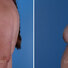 Breast reconstruction surgery before and after photos, left 90-degree angle view