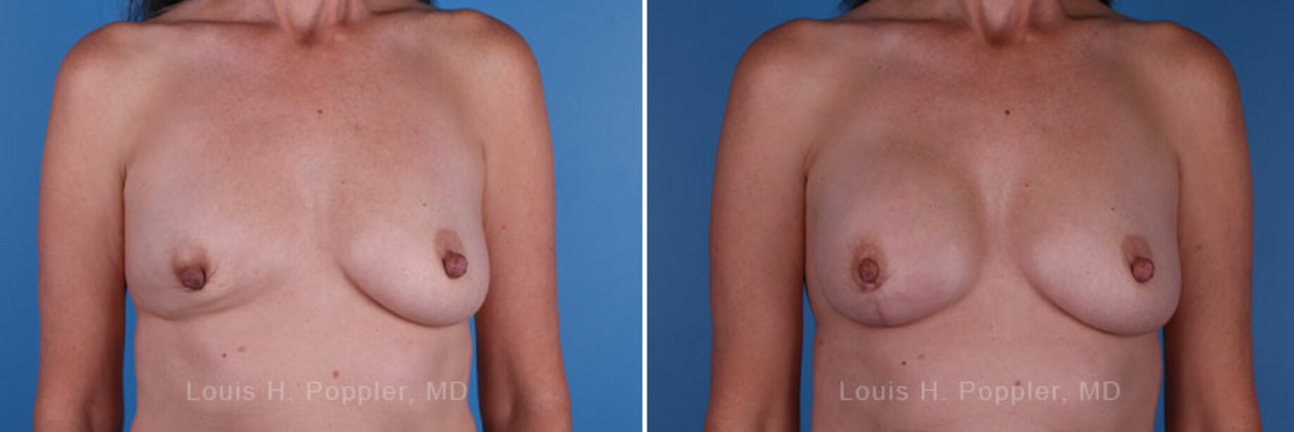Breast reconstruction surgery before and after photos