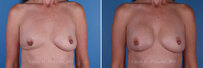 Breast reconstruction surgery before and after photos