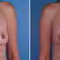 Breast reconstruction surgery before and after photos