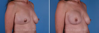 Breast reconstruction surgery before and after photos, right 45-degree angle view