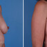 Breast reconstruction surgery before and after photos, right 45-degree angle view