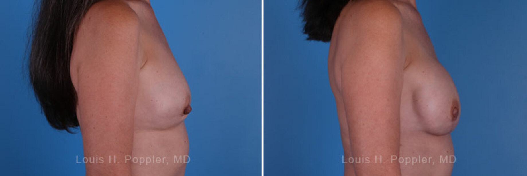 Breast reconstruction surgery before and after photos, right 90-degree angle view