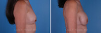 Breast reconstruction surgery before and after photos, right 90-degree angle view