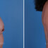 Breast reconstruction surgery before and after photos, right 90-degree angle view