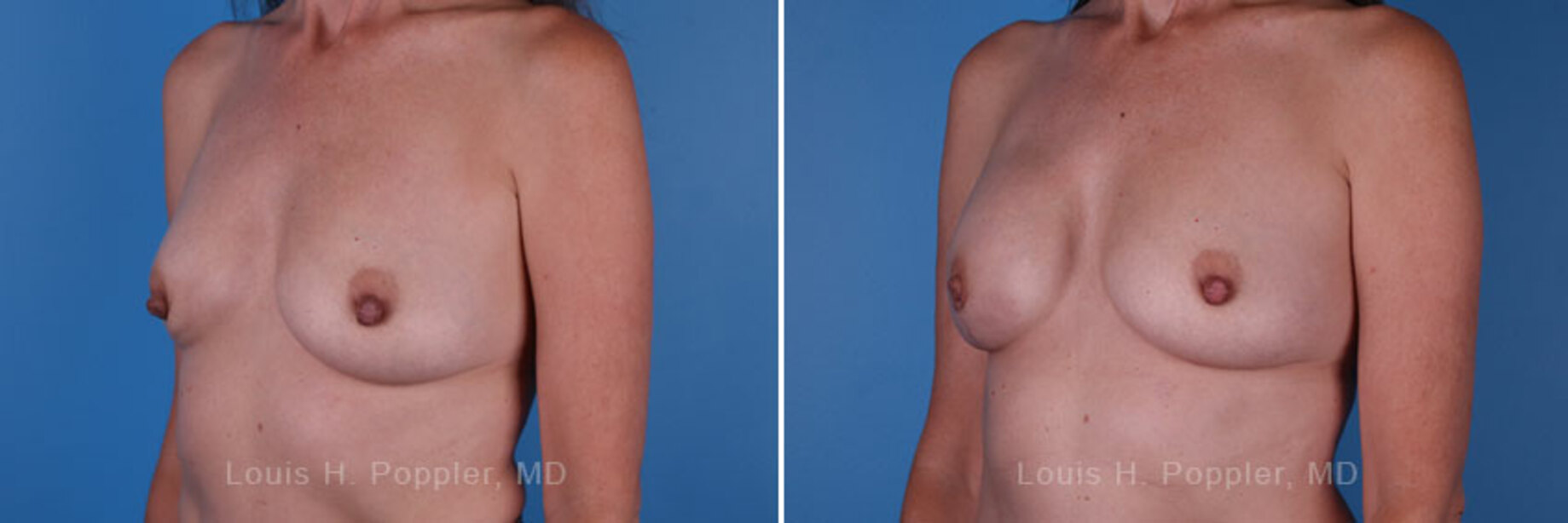 Breast reconstruction surgery before and after photos, left 45-degree angle view