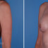 Breast reconstruction surgery before and after photos, left 45-degree angle view