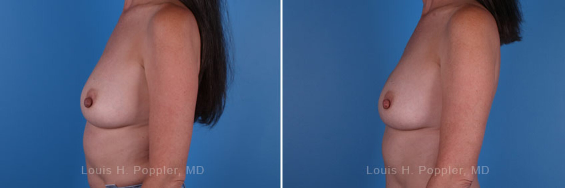 Breast reconstruction surgery before and after photos, left 90-degree angle view