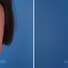 Breast reconstruction surgery before and after photos, left 90-degree angle view