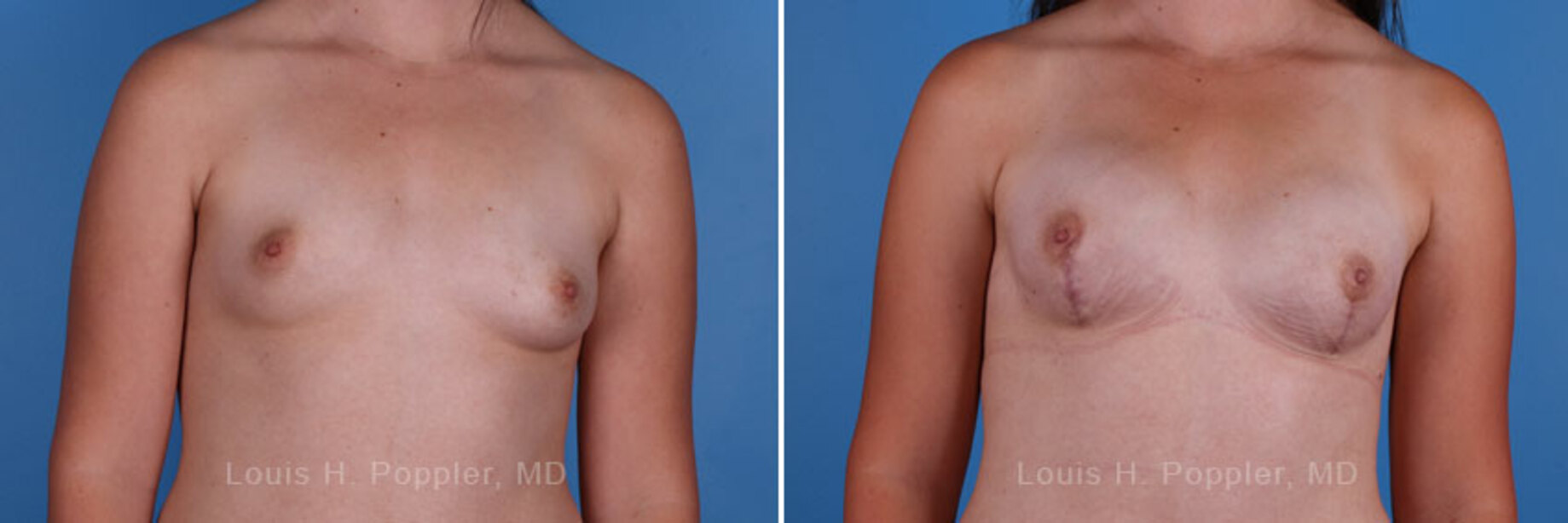 Breast reconstruction surgery before and after photos
