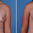 Breast reconstruction surgery before and after photos