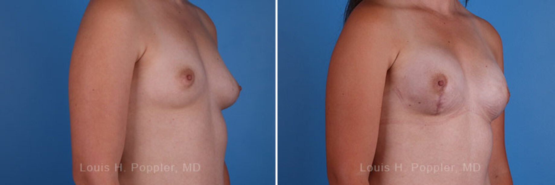 Breast reconstruction surgery before and after photos, right 45-degree angle view