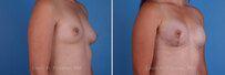 Breast reconstruction surgery before and after photos, right 45-degree angle view