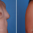 Breast reconstruction surgery before and after photos, right 45-degree angle view