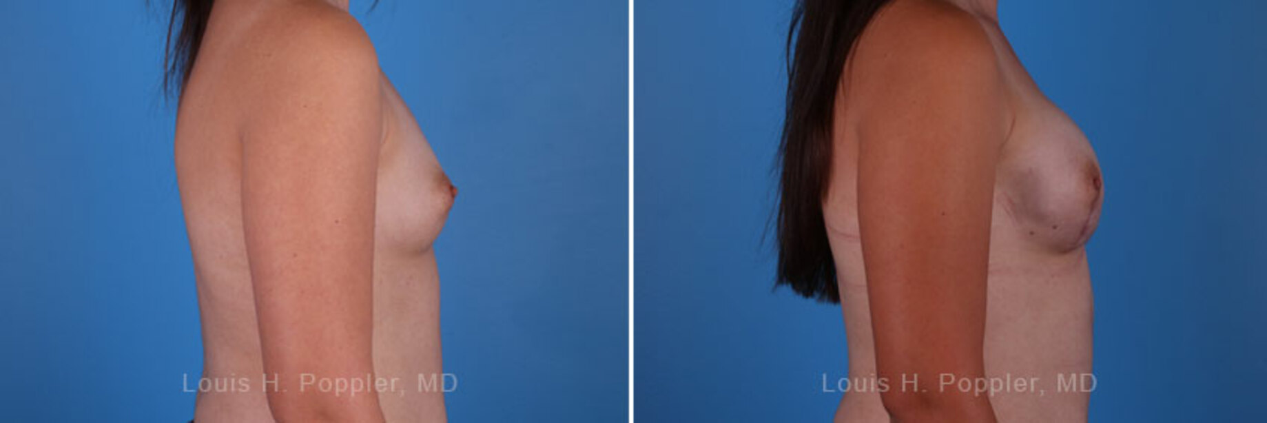 Breast reconstruction surgery before and after photos, right 90-degree angle view