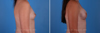 Breast reconstruction surgery before and after photos, right 90-degree angle view