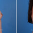 Breast reconstruction surgery before and after photos, right 90-degree angle view