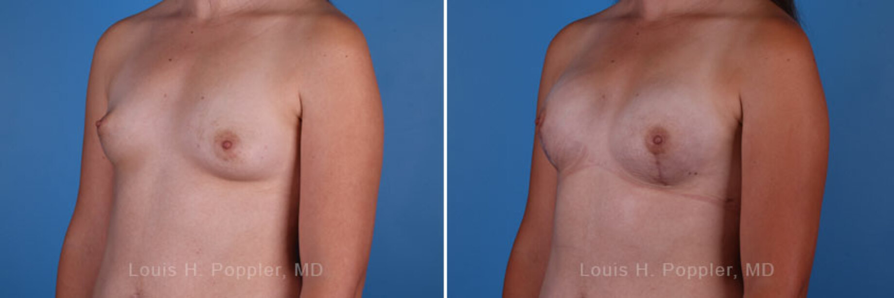 Breast reconstruction surgery before and after photos, left 45-degree angle view