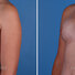Breast reconstruction surgery before and after photos, left 45-degree angle view