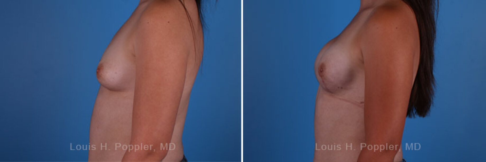 Breast reconstruction surgery before and after photos, left 90-degree angle view