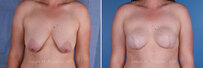 Breast reconstruction surgery before and after photos