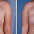 Breast reconstruction surgery before and after photos