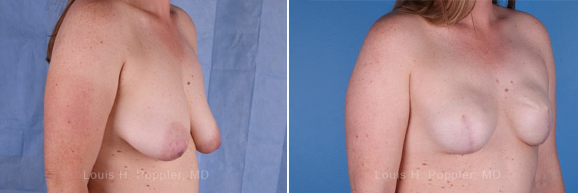 Breast reconstruction surgery before and after photos, right 45-degree angle view