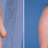 Breast reconstruction surgery before and after photos, right 45-degree angle view
