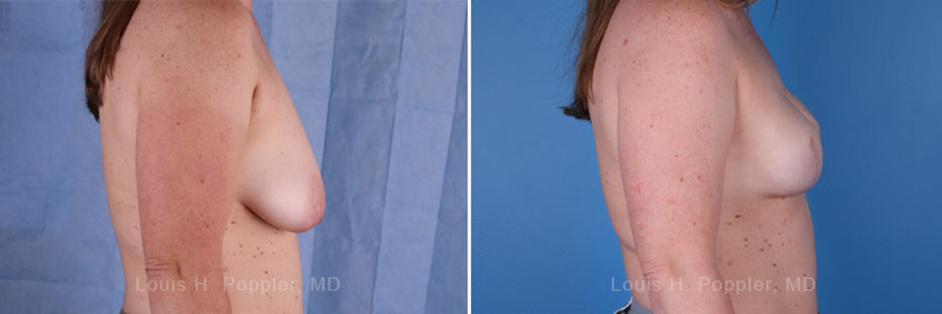 Breast reconstruction surgery before and after photos, right 90-degree angle view