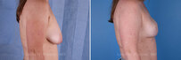Breast reconstruction surgery before and after photos, right 90-degree angle view