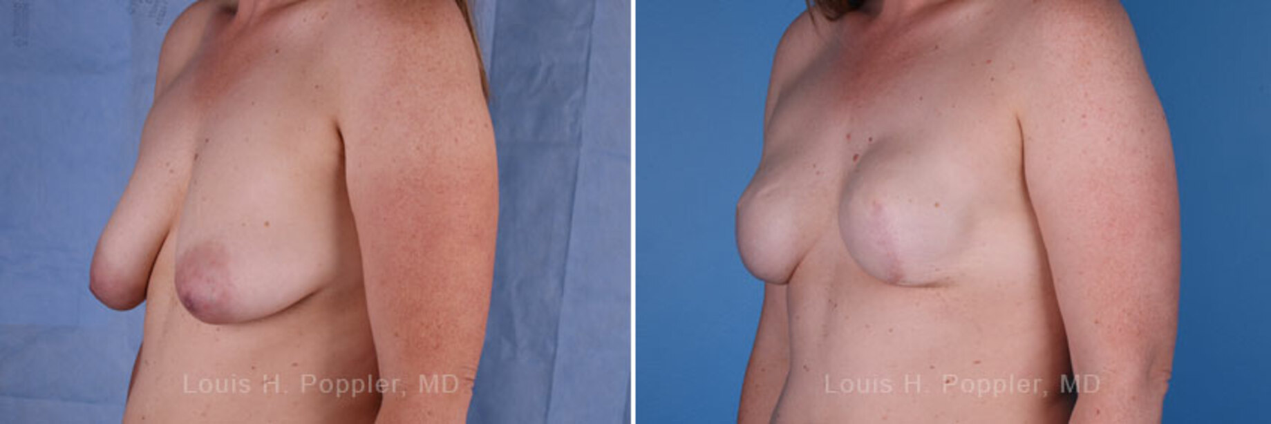 Breast reconstruction surgery before and after photos, left 45-degree angle view