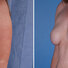 Breast reconstruction surgery before and after photos, left 45-degree angle view
