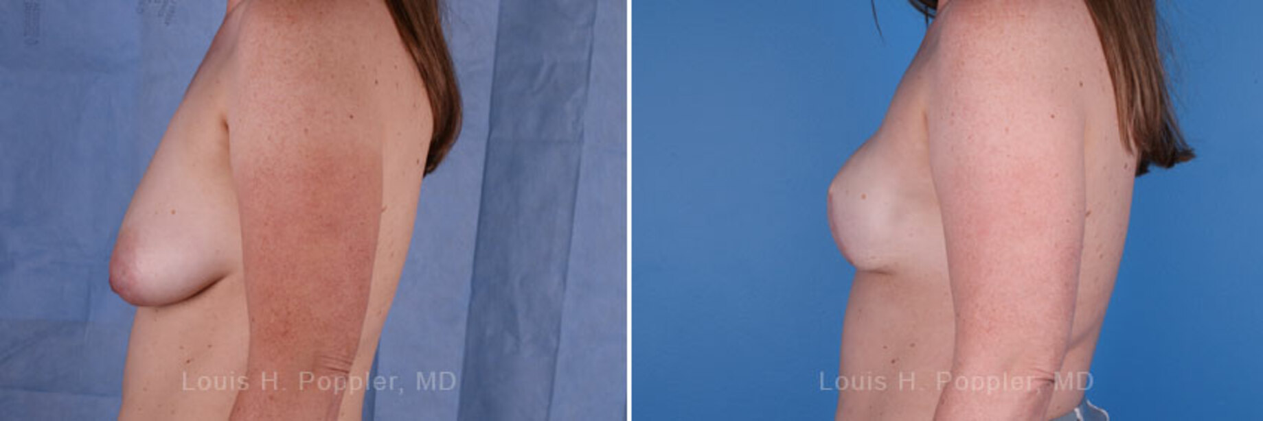 Breast reconstruction surgery before and after photos, left 90-degree angle view