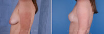 Breast reconstruction surgery before and after photos, left 90-degree angle view