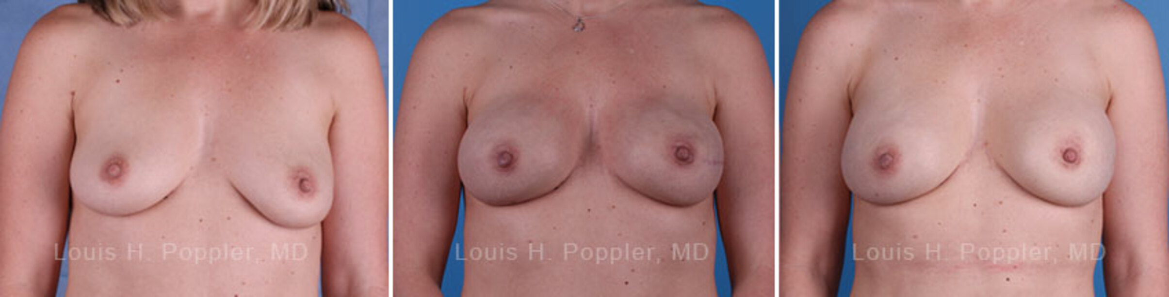 Breast reconstruction surgery before and after photos