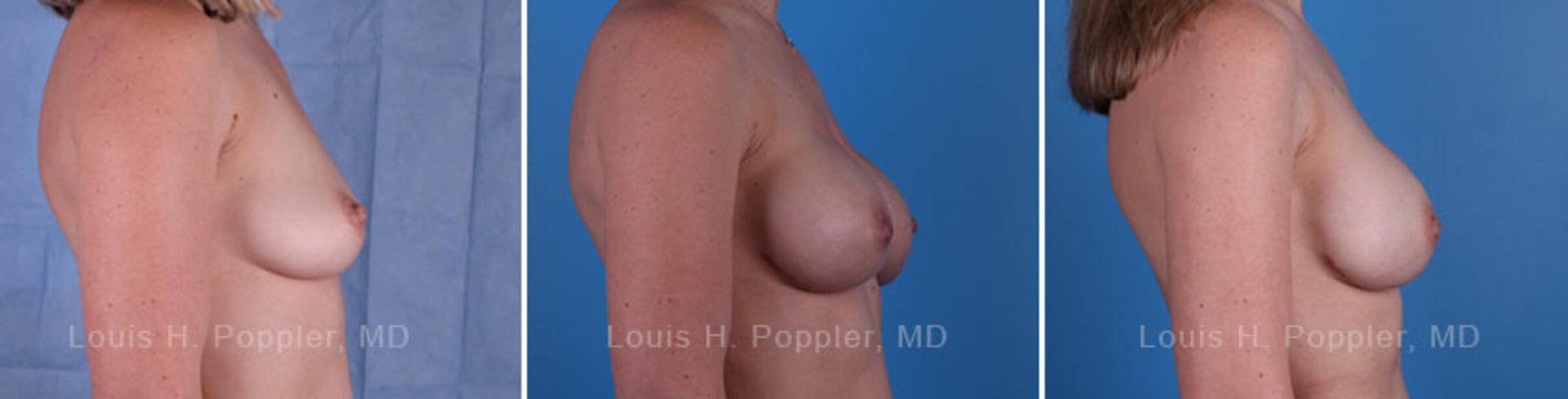 Breast reconstruction surgery before and after photos, right 90-degree angle view
