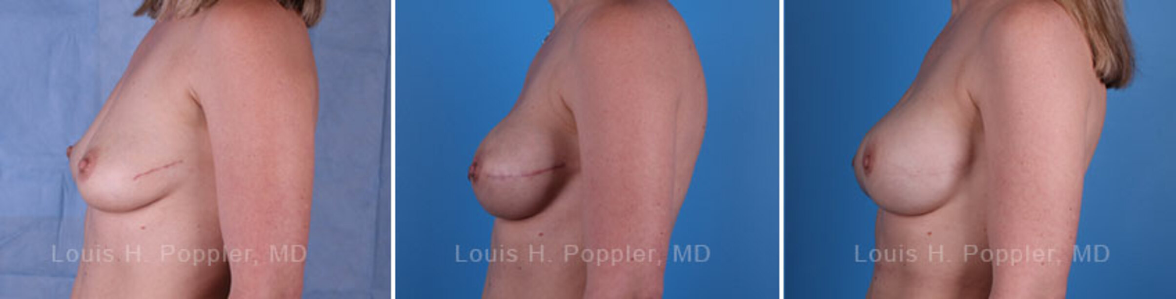 Breast reconstruction surgery before and after photos, left 90-degree angle view