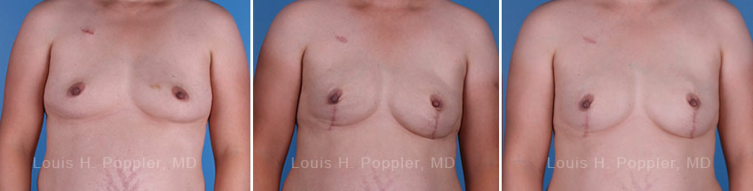 Breast reconstruction surgery before and after photos