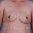 Breast reconstruction surgery before and after photos