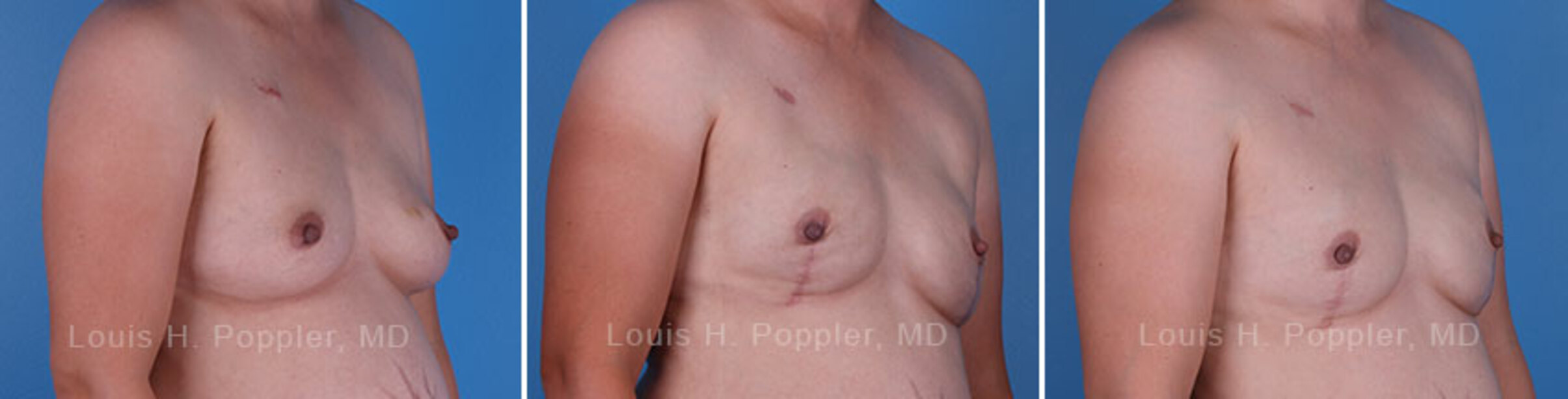 Breast reconstruction surgery before and after photos, right 45-degree angle view